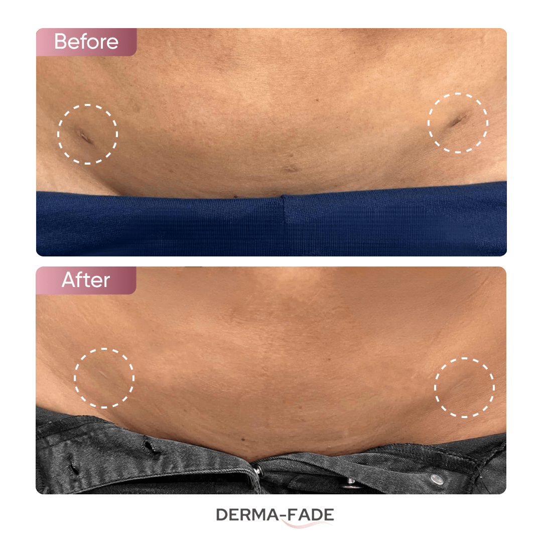 Derma - Fade™ Scar System (FREE serum limited time only) - Derma - Fade