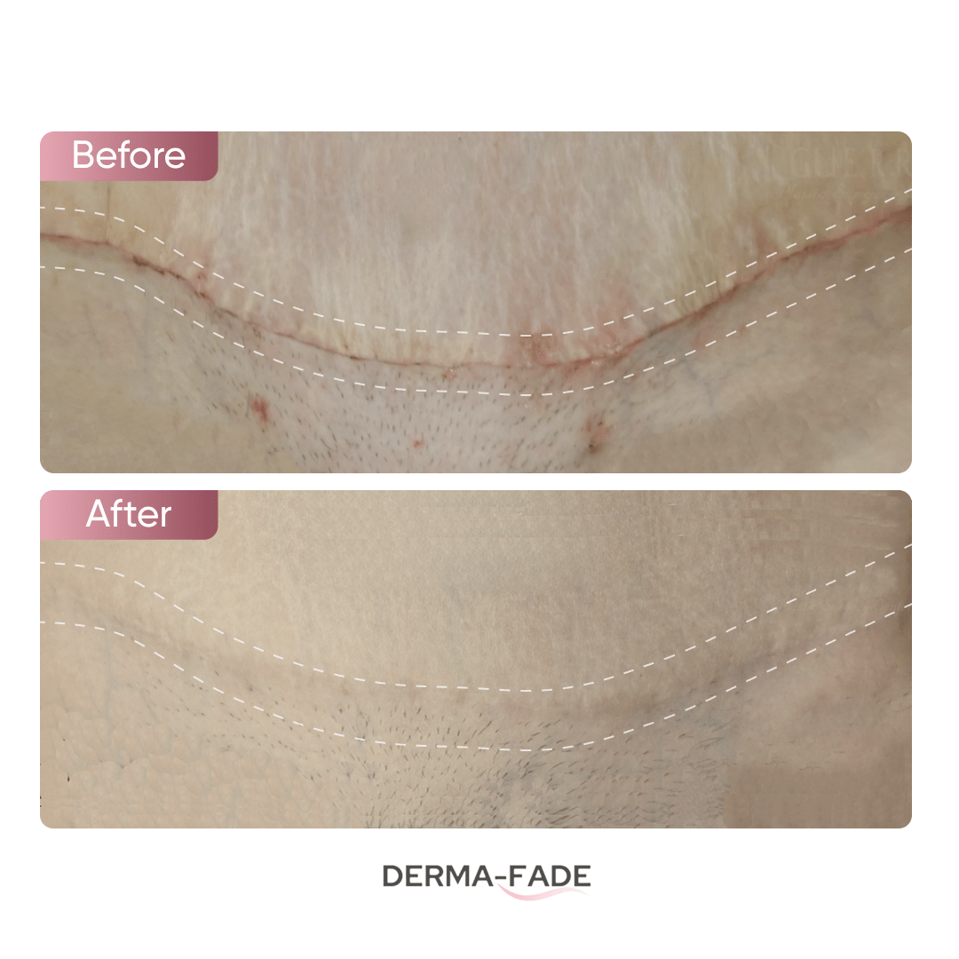 Derma - Fade™ Scar System (FREE serum limited time only) - Derma - Fade