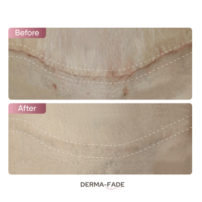 Derma - Fade™ Scar System (FREE serum limited time only) - Derma - Fade