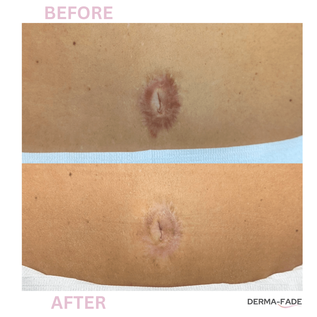 Derma - Fade - Derma - Fade