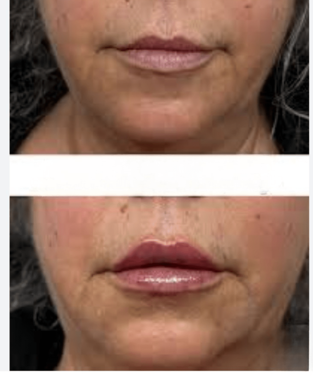 Derma - Plump Lip System - Derma - Fade