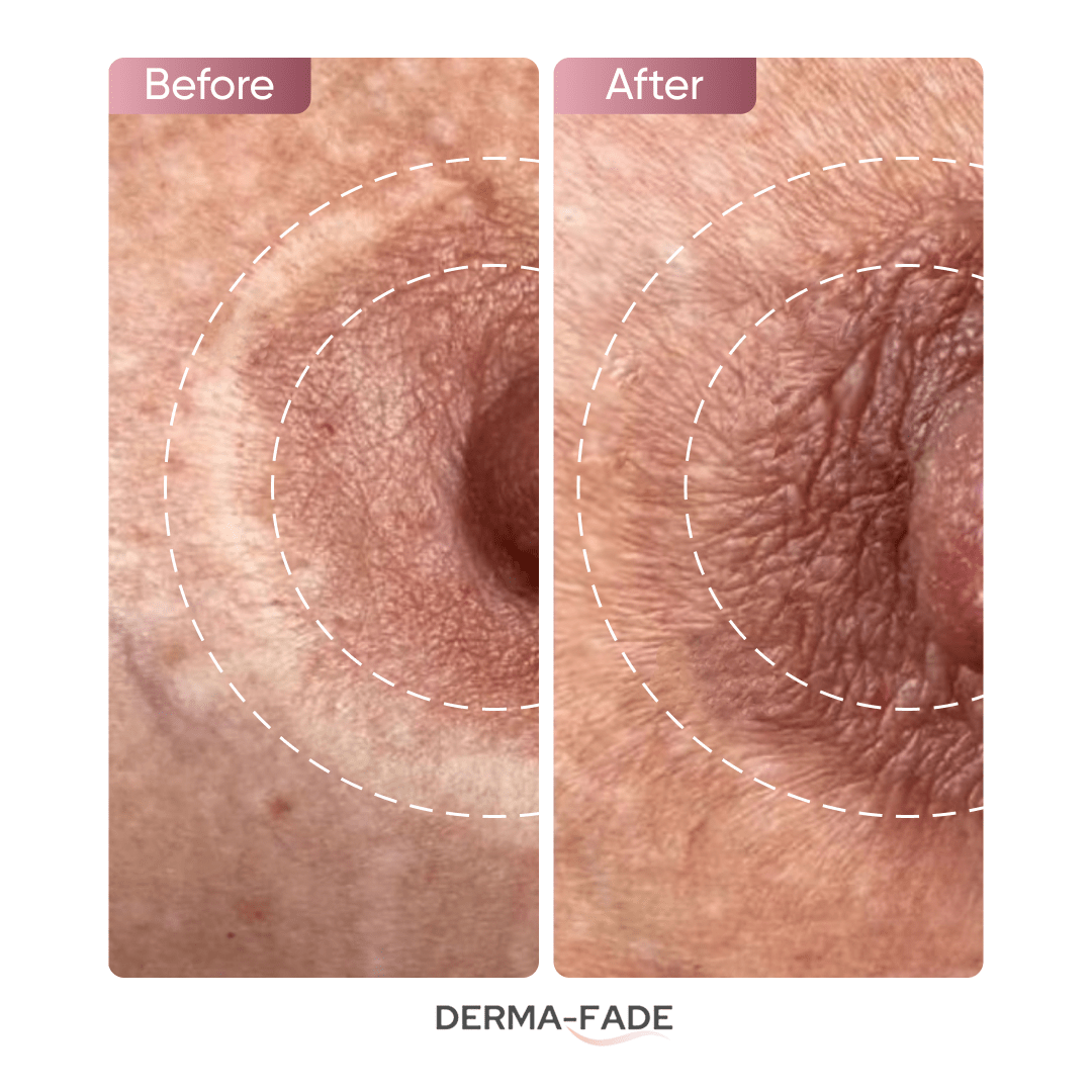 Derma - Fade™ Scar System (FREE serum limited time only) - Derma - Fade