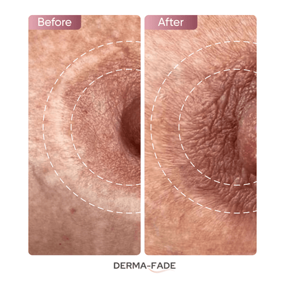 Derma - Fade™ Scar System (FREE serum limited time only) - Derma - Fade