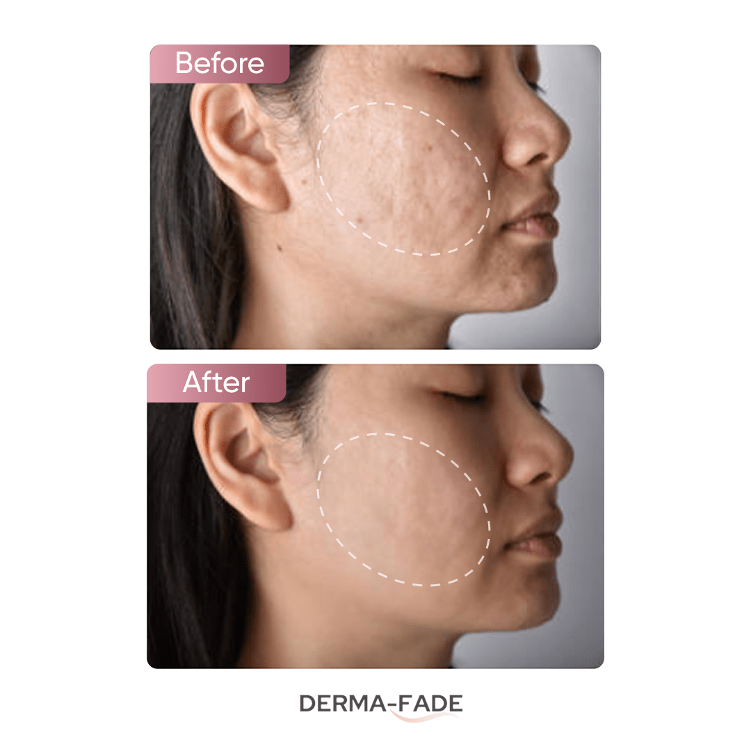Derma - Fade™ Scar System (FREE serum limited time only) - Derma - Fade