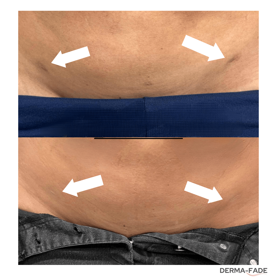 Derma - Fade - Derma - Fade