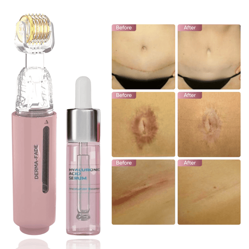 Derma - Fade Scar Treatment Kit + Free Serum - Derma - Fade